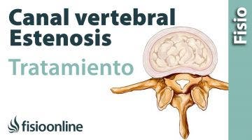 Estenosis de canal - Qué es y cómo se trata