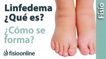 Linfa, edema o linfedema - Qué es y cómo se forma