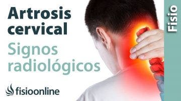 Artrosis cervical. Signos radiológicos