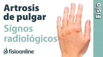 Rizartrosis o artrosis del pulgar. Signos radiológicos