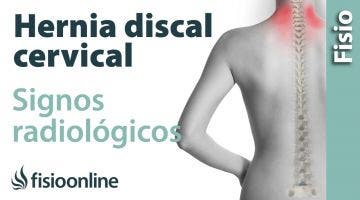 Hernia discal cervical. Signos radiológicos