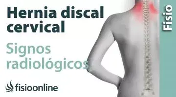 Hernia discal cervical. Signos radiológicos