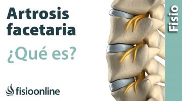 Artrosis facetaria vertebral. ¿Qué es?