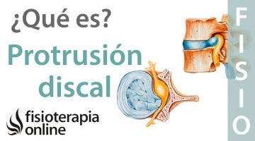 Protrusión discal subligamentosa. ¿Qué es?