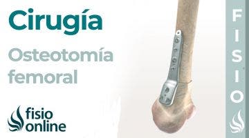 OSTEOTOMÍA FEMORAL: Técnica de la artrosis de rodilla sin prótesis