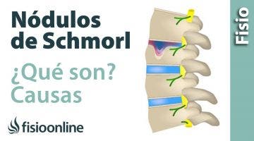 Nódulos de Schmorl. ¿Qué son y cómo sucede?