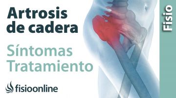 8# Artrosis o desgaste de cadera. Qué es, causas, síntomas y tratamiento.