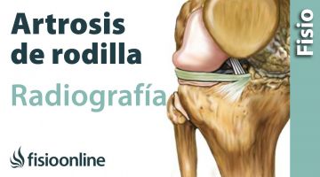 Artrosis de rodilla - Qué es y cómo se diagnostica en radiografías