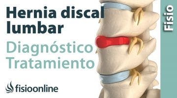 Hernia discal: Consejos, ejercicios y tratamiento de fisioterapia.