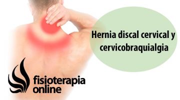 Hernia discal cervical y cérvico-braquialgia.