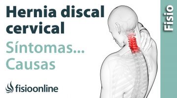 ¿Qué es la hernia discal cervical y cuáles son sus causas y síntomas?