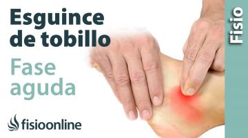 Esguince de tobillo grado 2-3 (moderado-grave). Tratamiento en fase aguda o reciente.