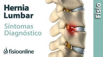 Cómo saber si tienes una hernia discal lumbar