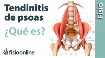 13# Tendinitis de psoas iliaco o psoitis. Qué es, causas, síntomas y tratamiento.