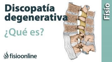 Discopatía degenerativa. ¿Qué es?