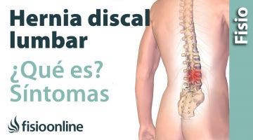 25 Hernia discal o de disco lumbar. Qué es, causas, síntomas y tratamiento.