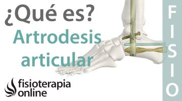 Artrodesis articular. Qué es, cuando y cómo se realiza