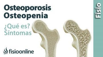 50# Osteoporosis y osteopenia. Qué es, causas, síntomas y tratamiento.