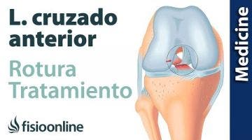 Lo que necesitas saber sobre la Rotura del Ligamento cruzado anterior (LCA)