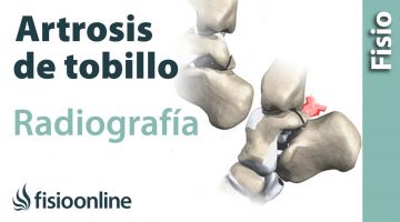Artrosis de tobillo - Qué es y cómo se diagnostica en radiografías