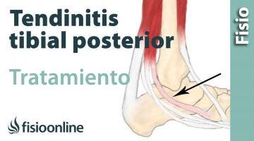 Tendinitis del tibial posterior