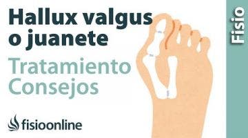 Halux Valgus o Juanete: Consejos y ejercicios para su tratamiento.