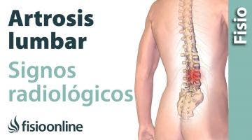 Artrosis lumbar. Signos radiológicos