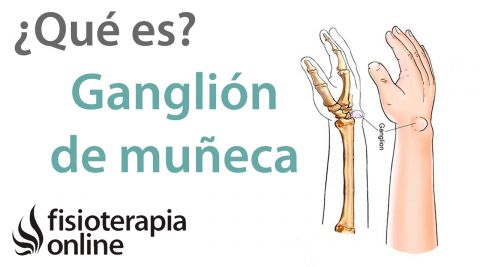 Ganglion de muñeca. ¿Qué es? | Fisioterapia Online