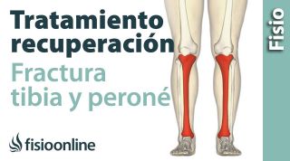 FRACTURA de TIBIA y PERONÉ.  Rehabilitación, ejercicios y tiempo de recuperación