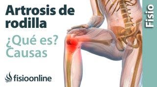 9 Artrosis o desgaste de rodilla. Qué es, causas, síntomas y tratamiento.