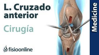 CIRUGÍA del LIGAMENTO CRUZADO ANTERIOR