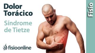 Qué es el síndrome de TIETZE  y su tratamiento(o síndrome condroesternal)