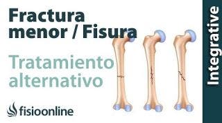 42 Fracturas menores y fisuras. Otra forma de orientar su tratamiento.