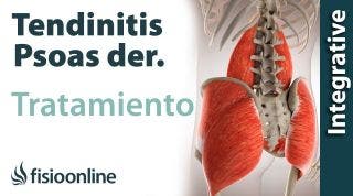 Tratamiento de la tendinitis del psao derecho o Psoitis derecha