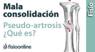 41 ¿Qué es la Pseudoartrosis o mala consolidación de fracturas.?