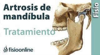 Artrosis de mandíbula - Qué es, causas, síntomas y tratamiento