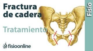 14.Fracturas de femur, cadera y pelvis. Fases de curación y tratamiento.