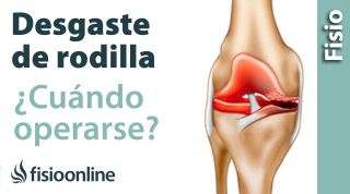 arttrosis de rodilla:  cuándo operarse y pornerse una protesis