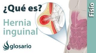 HERNIA INGUINAL | Qué es, qué afecta, síntomas, , causas y tratamiento fisioterapéutico