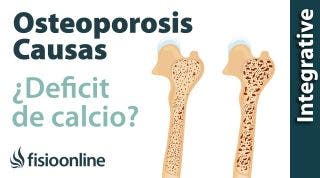 Osteoporosis, ¿un déficit de calcio?
