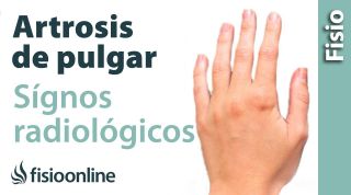 Rizartrosis o artrosis del pulgar. Signos radiológicos