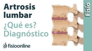 Artrosis lumbar - Qué es y cómo se diagnostica en radiografías