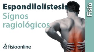 Espondilolisis y Espondilolistesis - Signos radiológicos.
