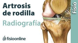 Artrosis de rodilla - Qué es y cómo se diagnostica en radiografías