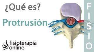 Protrusión o complejos disco osteofitarios posteriores. ¿Qué es?