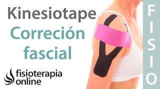 9 Técnica de correción fascial del Kinesiotaping