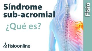 ¿Qué es el síndrome subacromial o síndrome de impactación?