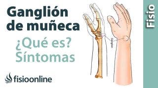 11# Ganglión de muñeca o muñeca abierta. Qué es, causas, síntomas y tratamiento.