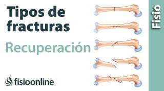 Tipos de FRACTURAS de hueso y su tratamiento y recuperación