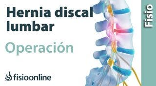 Hernia discal lumbar. Operación quirúrgica o cirugía